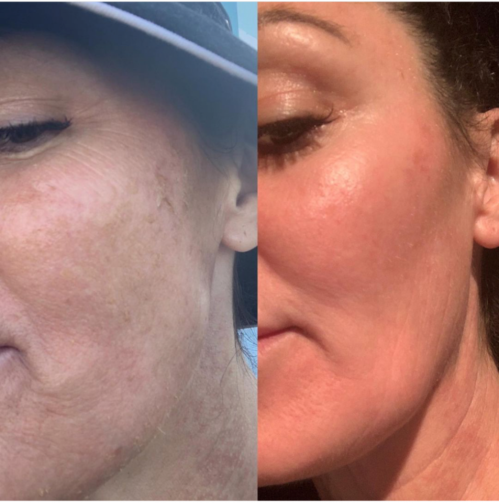 chemical-peel-before-after